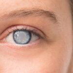 How to treat Cataract?