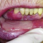 What is mucositis and its causes and symptoms?