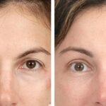 How Brow Lifting Technique Can Uplift Your Looks Instantly?