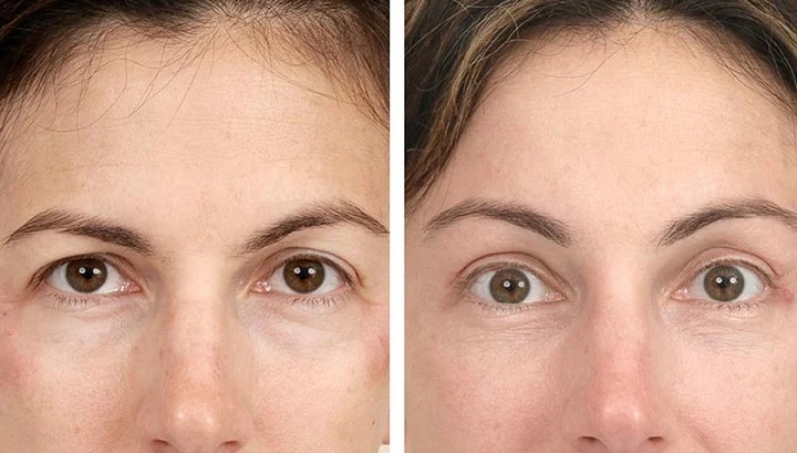 How Brow Lifting Technique Can Uplift Your Looks Instantly?