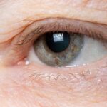 What Are Droopy Eyelids And Who Should Get It Done